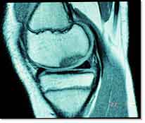 MRI of the Osteochondral Defect of the Medial Femoral Condyle