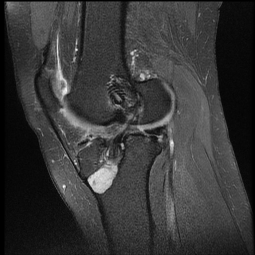 ACL graft tibial cyst