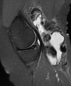 MRI - Baker's Cyst with PVNS