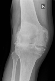 XR - Lateral OA with Valgus Angular Deformity