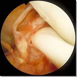 Displaced Bucket-handle Tear of the Medial Meniscus